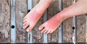 burning feet syndrome