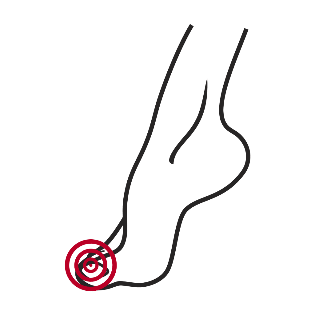 Ingrown Toenails Netstep