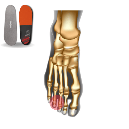Custom Morton Extension Orthotics Netstep