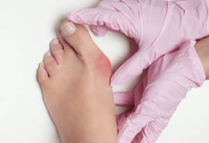 What Are Bunions - symptoms