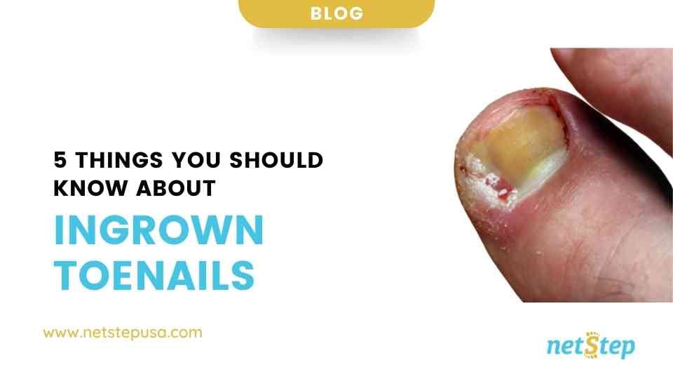 5 Things You Should Know About Ingrown Toenails