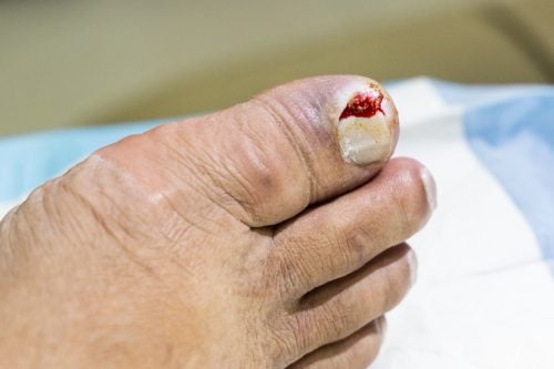 5 Things You Should Know About Ingrown Toenails 